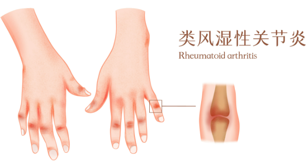 邵陽創(chuàng)傷骨科,邵陽風(fēng)濕病區(qū),邵陽骨質(zhì)增生,邵陽關(guān)節(jié)病區(qū),邵陽頸椎病區(qū)